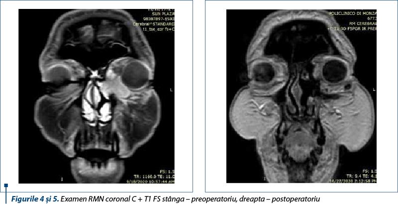 Figurile 4 şi 5. Examen RMN coronal C + T1 FS stânga – preoperatoriu, dreapta – postoperatoriu