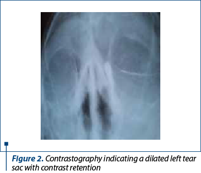 Figure 2. Contrastography indicating a dilated left tear sac with contrast retention