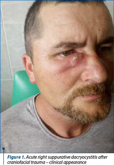Figure 1. Acute right suppurative dacryocystitis after craniofacial trauma – clinical appearance 