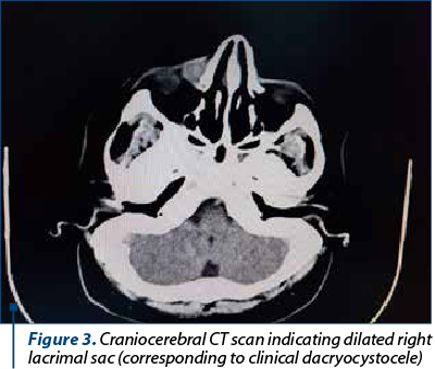 Figure 3. Craniocerebral CT scan indicating dilated right lacrimal sac (corresponding to clinical dacryocystocele)