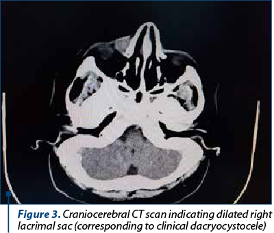 Figure 3. Craniocerebral CT scan indicating dilated right lacrimal sac (corresponding to clinical dacryocystocele)