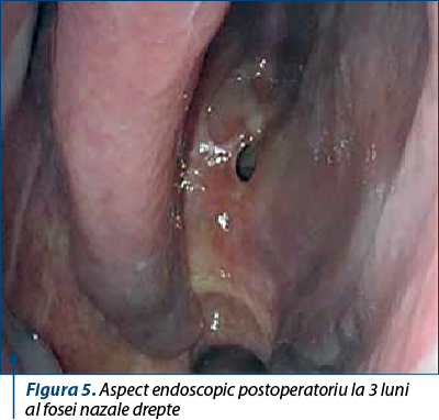 Figura 5. Aspect endoscopic postoperatoriu la 3 luni  al fosei nazale drepte