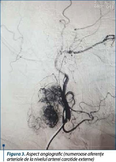 Figura 3. Aspect angiografic (numeroase aferenţe arteriale de la nivelul arterei carotide externe)