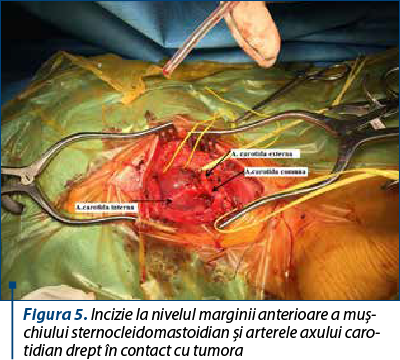 Figura 5. Incizie la nivelul marginii anterioare a muş­chiului sternocleidomastoidian şi arterele axului caro­tidian drept în contact cu tumora