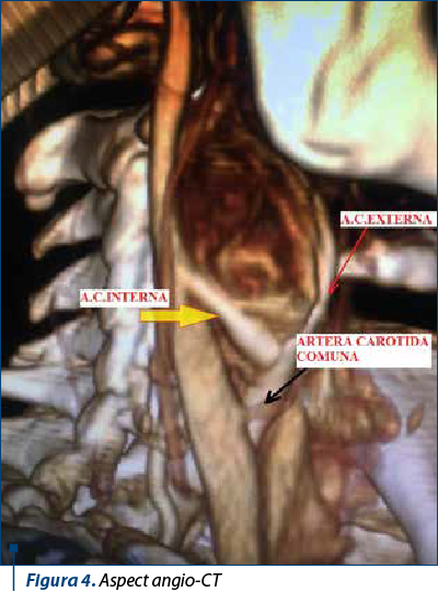 Figura 4. Aspect angio-CT