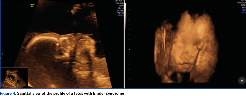 Figure 4. Sagittal view of the profile of a fetus with Binder syndrome