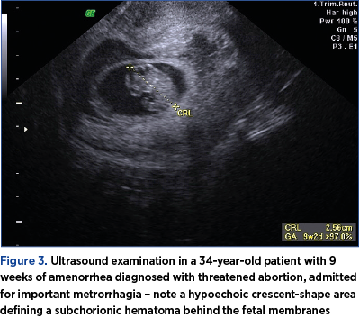 Figure 3. Ultrasound examination in a 34-year-old patient with 9 weeks of amenorrhea diagnosed with threatened abortion, admitted for important metrorrhagia – note a hypoechoic crescent-shape area defining a subchorionic hematoma behind the fetal membranes