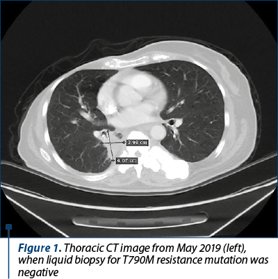 Figure 1. Thoracic CT image from May 2019 (left), when liquid biopsy for T790M resistance mutation was negative
