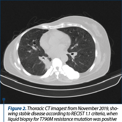 Figure 2. Thoracic CT imagest from November 2019, sho­wing stable disease according to RECIST 1.1 criteria, when liquid biopsy for T790M resistance mutation was positive