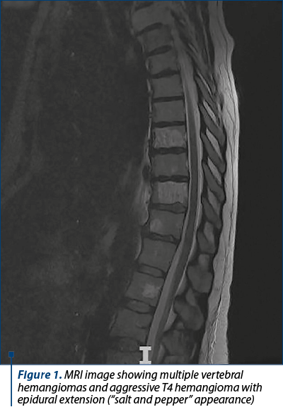 Figure 1. MRI image showing multiple vertebral hemangiomas and aggressive T4 hemangioma with epidural extension (“salt and pepper” appearance) 