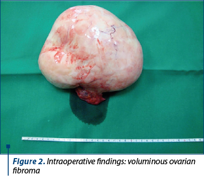 Figure 2. Intraoperative findings: voluminous ovarian fibroma