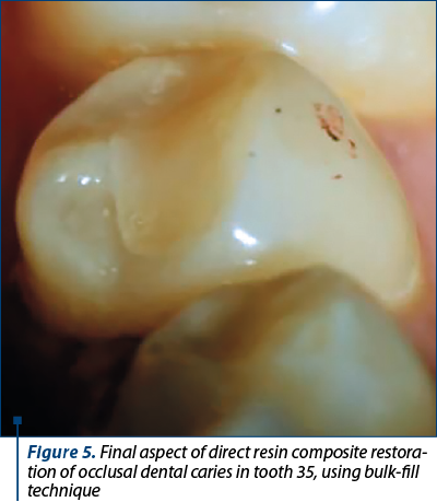 Figure 5. Final aspect of direct resin composite restora­tion of occlusal dental caries in tooth 35, using bulk-fill tech­nique 