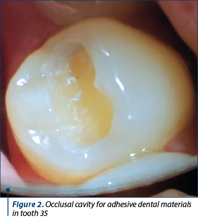 Figure 2. Occlusal cavity for adhesive dental materials in tooth 35 