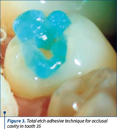 Figure 3. Total etch adhesive technique for occlusal cavity in tooth 35 