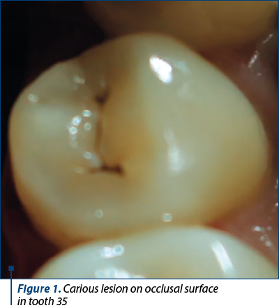 Figure 1. Carious lesion on occlusal surface  in tooth 35 