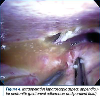 Figure 4. Intraoperative laparoscopic aspect: appen­di­cu­lar peritonitis (peritoneal adherences and purulent fluid)