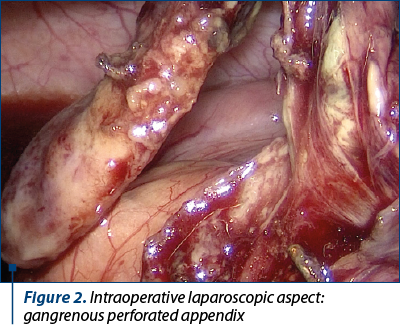 Figure 2. Intraoperative laparoscopic aspect: gangrenous perforated appendix
