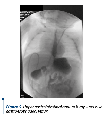 Figure 5. Upper gastrointestinal barium X-ray – massive gastroesophageal reflux