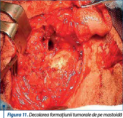 Figura 11. Decolarea formaţiunii tumorale de pe mastoidă