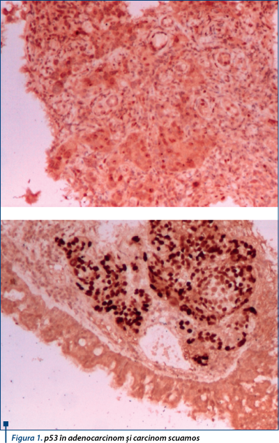 Figura 1. p53 în adenocarcinom şi carcinom scuamos