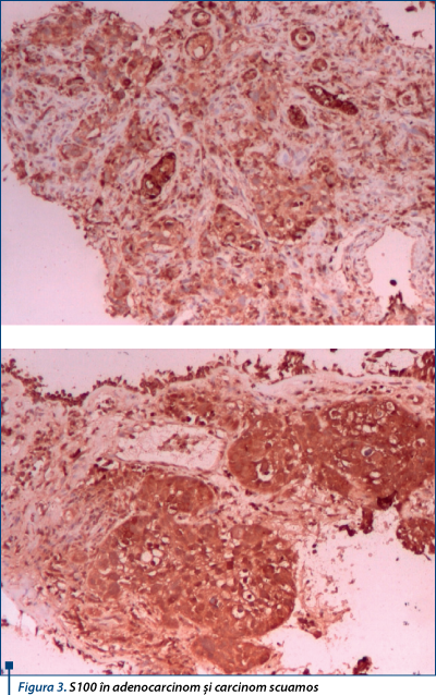 Figura 3. S100 în adenocarcinom şi carcinom scuamos