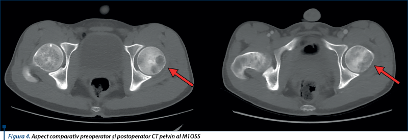 Figura 4. Aspect comparativ preoperator şi postoperator CT pelvin al M1OSS