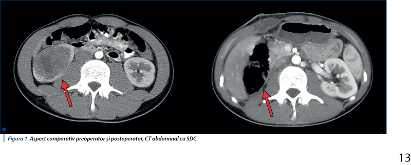 Figura 1. Aspect comparativ preoperator şi postoperator, CT abdominal cu SDC