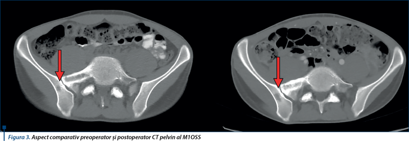 Figura 3. Aspect comparativ preoperator şi postoperator CT pelvin al M1OSS 