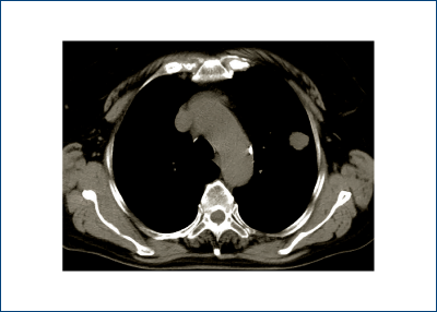 Figure 1. Native CT scan image of a left solitary pulmonary nodule 