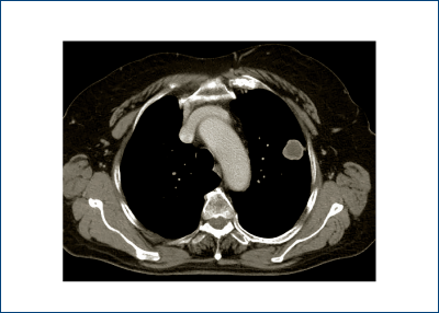Figure 2. Contrast-enhanced CT scan image of the same solitary pulmonary nodule as in figure 1; the 