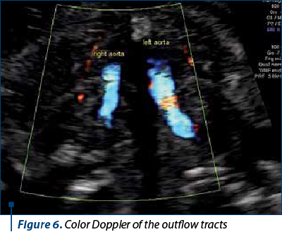Figure 6. Color Doppler of the outflow tracts