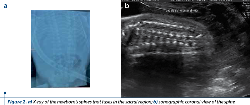Figure 2. a) X-ray of the newborn’s spines that fuses in the sacral region; b) sonographic coronal view of the spine
