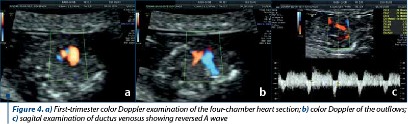 Figure 4. a) First-trimester color Doppler examination of the four-chamber heart section; b) color Doppler of the outflows; c) sagital examination of ductus venosus showing reversed A wave