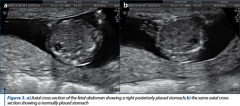 Figure 3. a) Axial cross-section of the fetal abdomen showing a right posteriorly placed stomach; b) the same axial cross-section showing a normally placed stomach