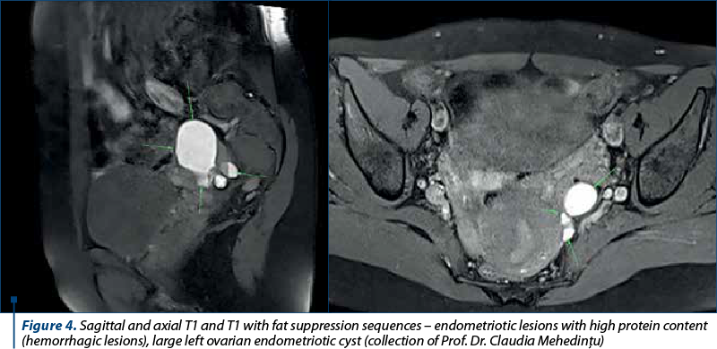Figure 4. Sagittal and axial T1 and T1 with fat suppression sequences – endometriotic lesions with high protein content (hemorrhagic lesions), large left ovarian endometriotic cyst (collection of Prof. Dr. Claudia Mehedinţu)