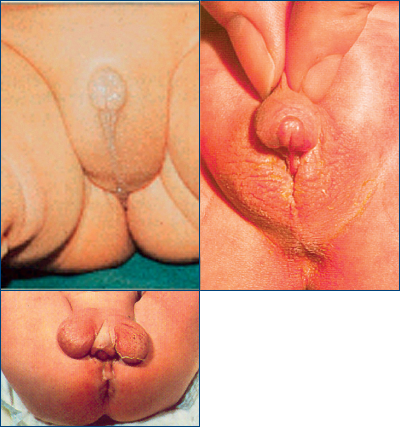Figura 13. Modificări de organe genitale externe, observabile la naştere. (Sursa: Georgescu, 2005)
