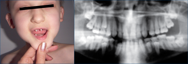 Figura 8. Aspect clinic şi radiografie panoramică cu dentiţie dublă
