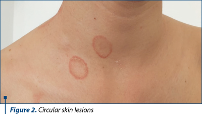 Figure 2. Circular skin lesions