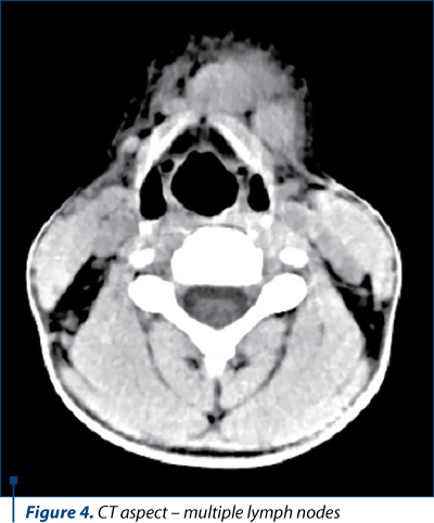 Figure 4. CT aspect – multiple lymph nodes