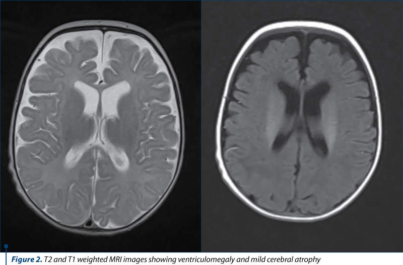 Figure 2. T2 and T1 weighted MRI images showing ventriculomegaly and mild cerebral atrophy