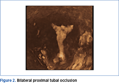 Figure 2. Bilateral proximal tubal occlusion