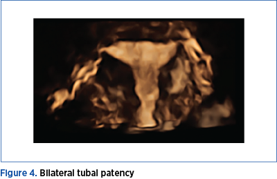 Figure 4. Bilateral tubal patency