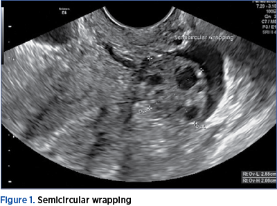 Figure 1. Semicircular wrapping
