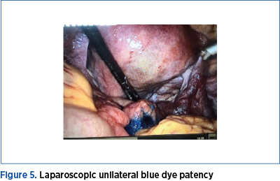 Figure 5. Laparoscopic unilateral blue dye patency