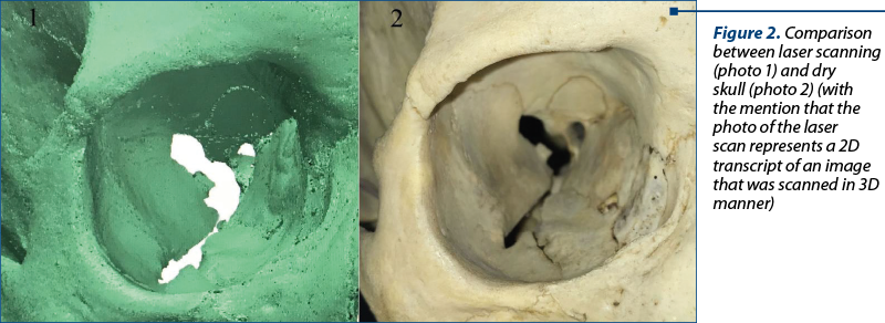 Figure 2. Comparison between laser scanning (photo 1) and dry skull (photo 2) (with the mention that the photo of the laser scan represents a 2D transcript of an image that was scanned in 3D manner)