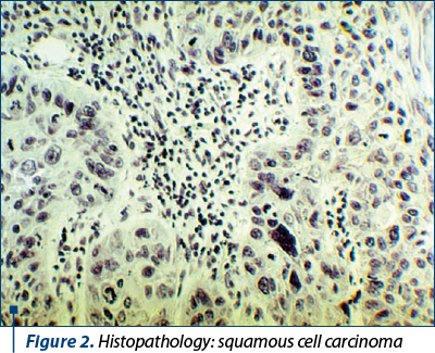 Figure 2. Histopathology: squamous cell carcinoma