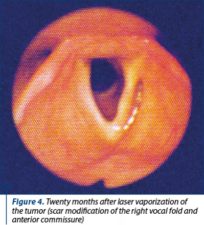 Figure 4. Twenty months after laser vaporization of the tumor (scar modification of the right vocal fold and anterior commissure)