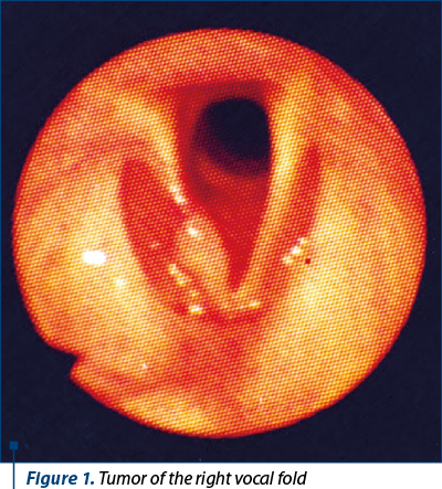 Figure 1. Tumor of the right vocal fold 