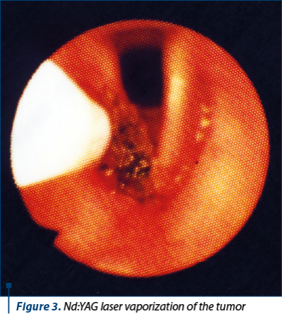 Figure 3. Nd:YAG laser vaporization of the tumor