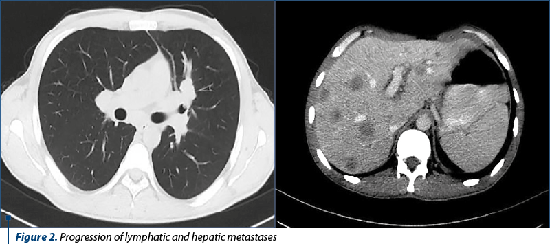 Figure 2. Progression of lymphatic and hepatic metastases 